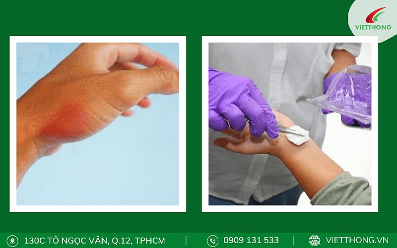 Cách sơ cứu khi bị rết cắn tức thời