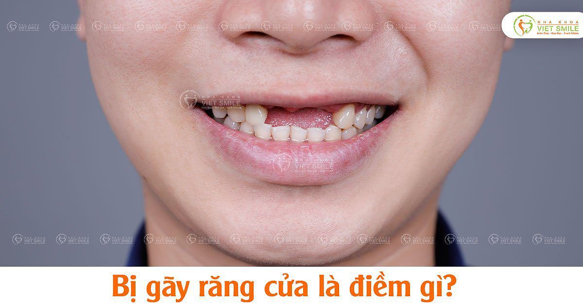 Hình ảnh mô tả tình trạng gãy răng cửa và tác động của nó đến sức khỏe răng miệng.